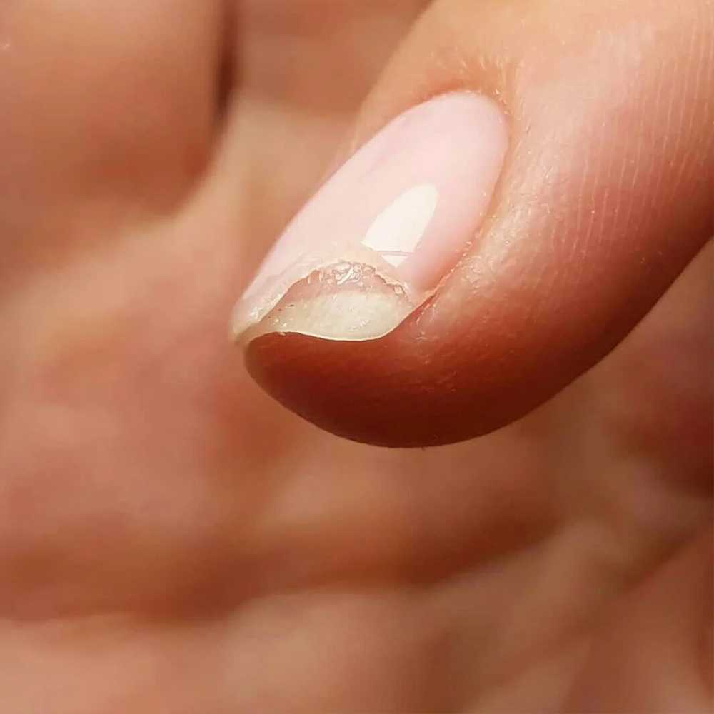 Ремонт ногтя гель-лаком. ремонт трещины и скола